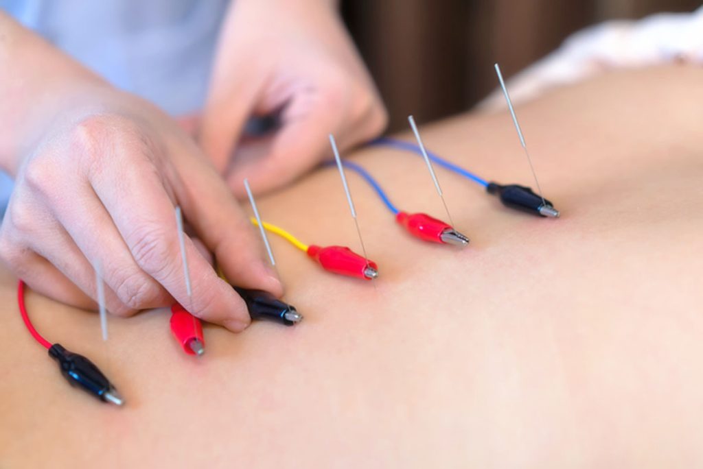 Electrical Stimulation of Acupuncture Needles